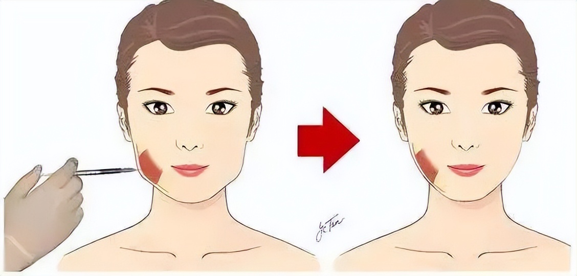 韦敏教授怎么样,瘦脸针和咬肌切除该怎么选