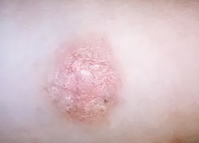 检查单上：外阴单纯性苔藓跟硬化性苔藓的区别