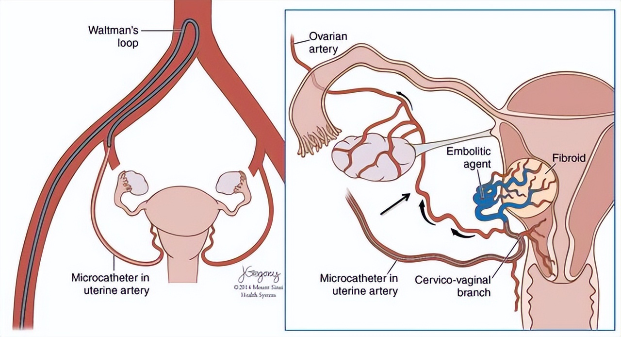 47岁女性肌瘤手术,40岁因子宫肌瘤切除子宫