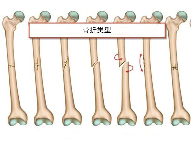 骨折是指什么意思,骨折是什么症状什么感觉