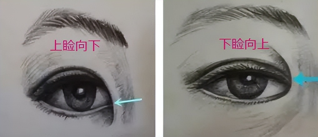 内眦赘皮用手术吗,内眼角内眦赘皮矫正不做手术