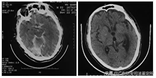 脑部神经损伤司法鉴定需要做哪些,司法鉴定颅内出血是轻伤还是重伤