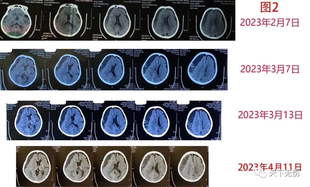 慢性硬膜下血肿的微创手术治疗,慢性硬膜下血肿激素治疗