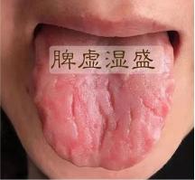 舌头上有裂纹是哪出现了问题,舌头上有裂纹加重是什么原因