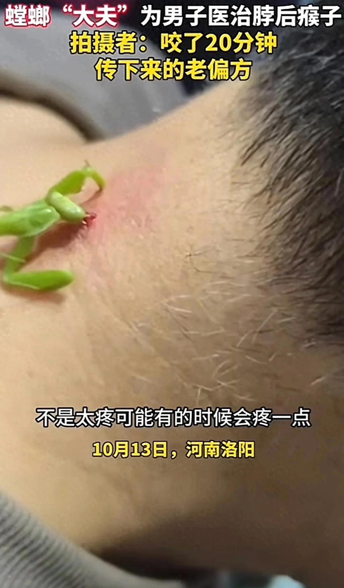 螳螂医治男子脖子后刺瘊,老中医用螳螂治疗脖子上的瘊子
