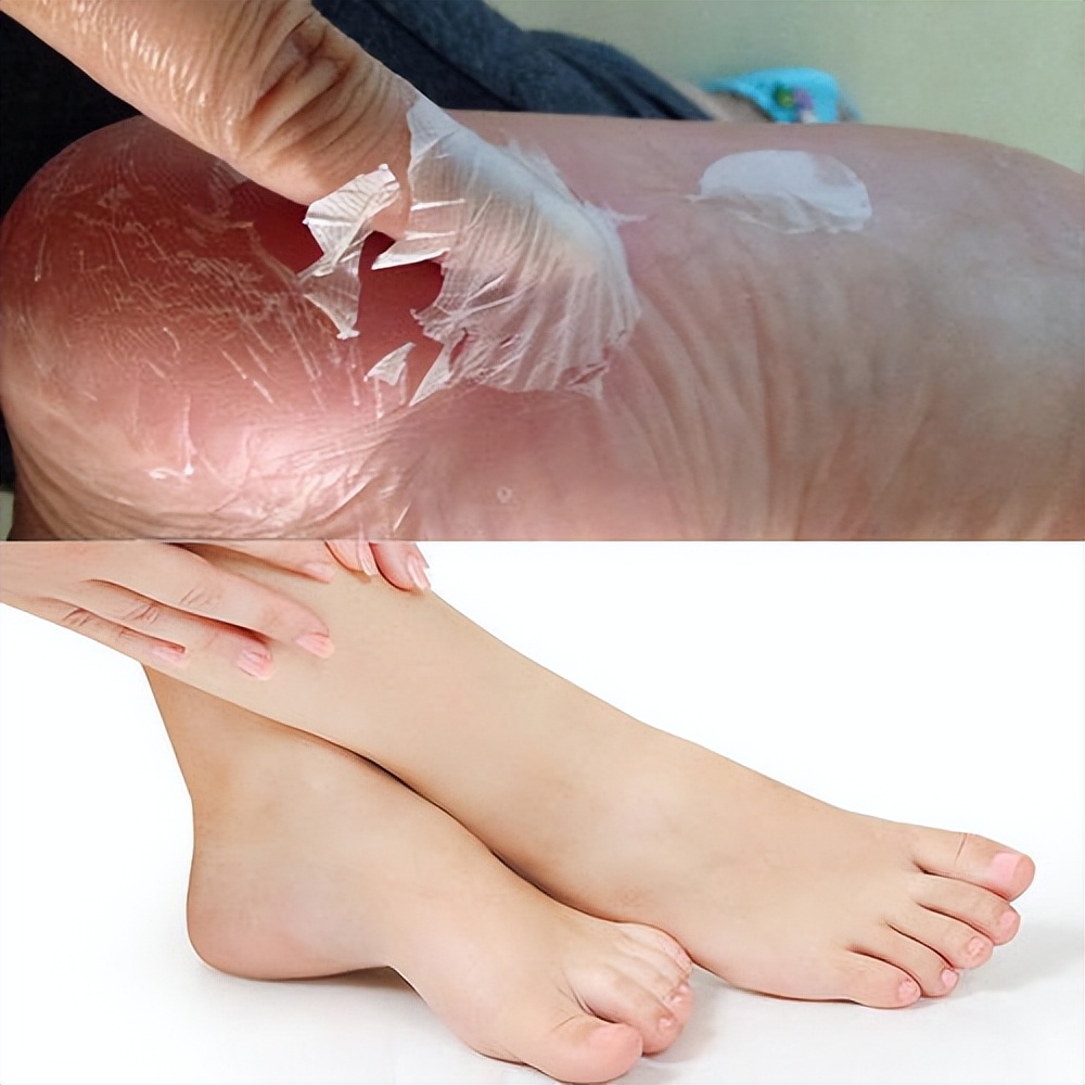 维a酸乳膏可以改善毛孔粗大吗,油皮毛孔粗大黑头多要怎么改善