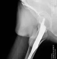 烟台海港医院用新技术PFBN助力，治疗股骨粗隆间骨折