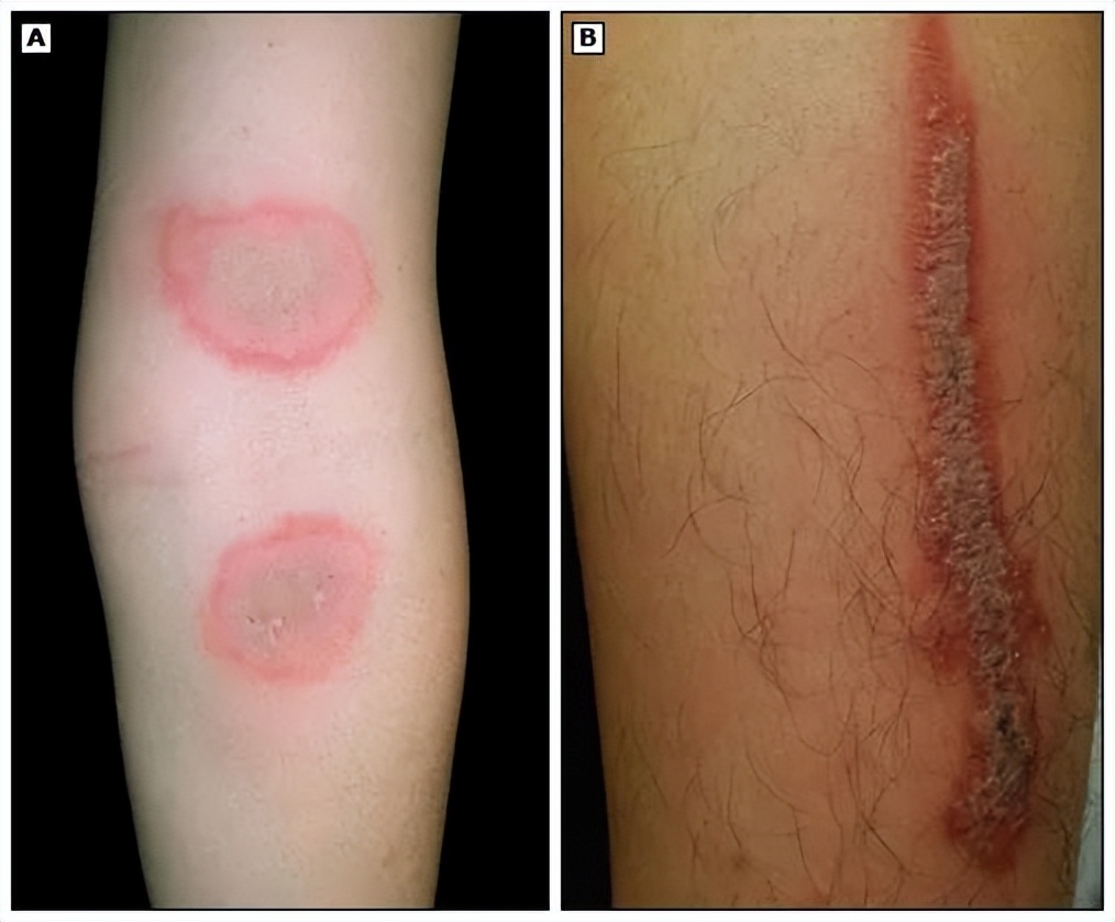 小宝宝出门怎么防护毒虫,带孩子出去玩当心这种虫子