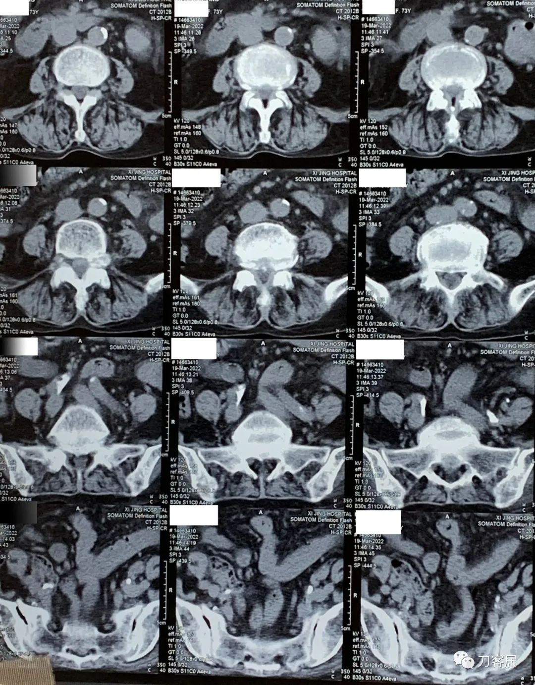 75岁老人腰间盘突出可以做手术吗,70岁老人腰间盘突出做手术