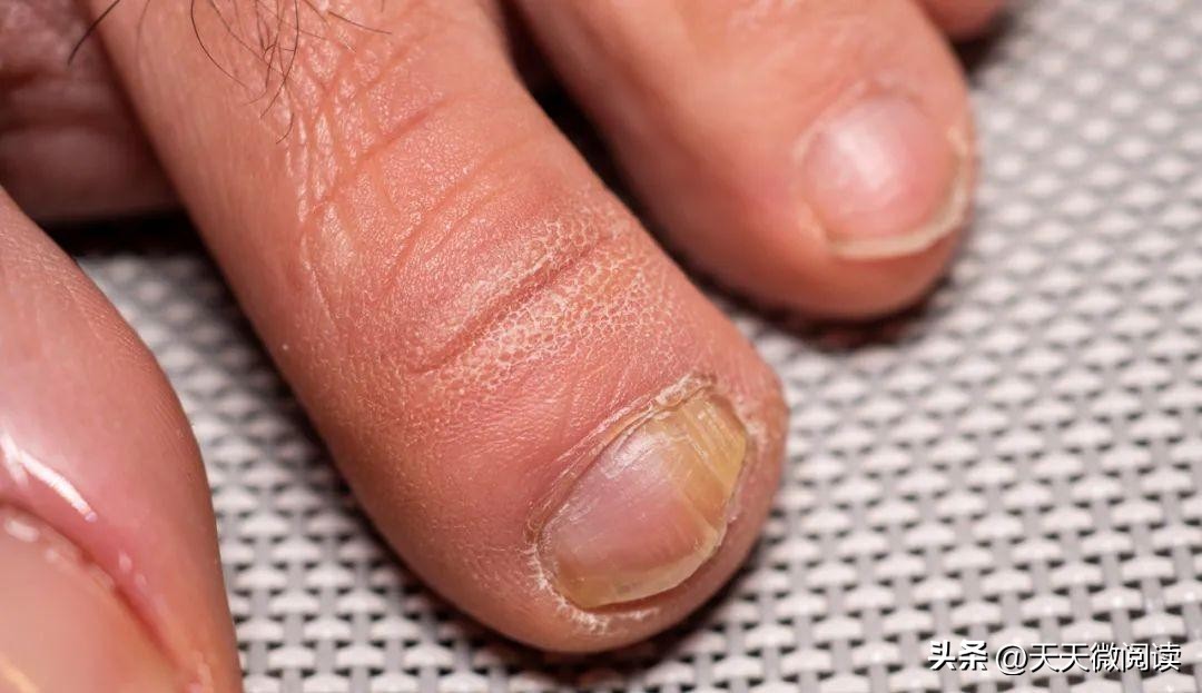指甲有竖纹口臭老放屁是怎么回事,指甲有竖痕代表身体哪里不健康呢