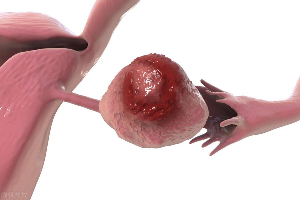 20岁女孩检查双子宫,女生24岁检查出来双子宫怎么办