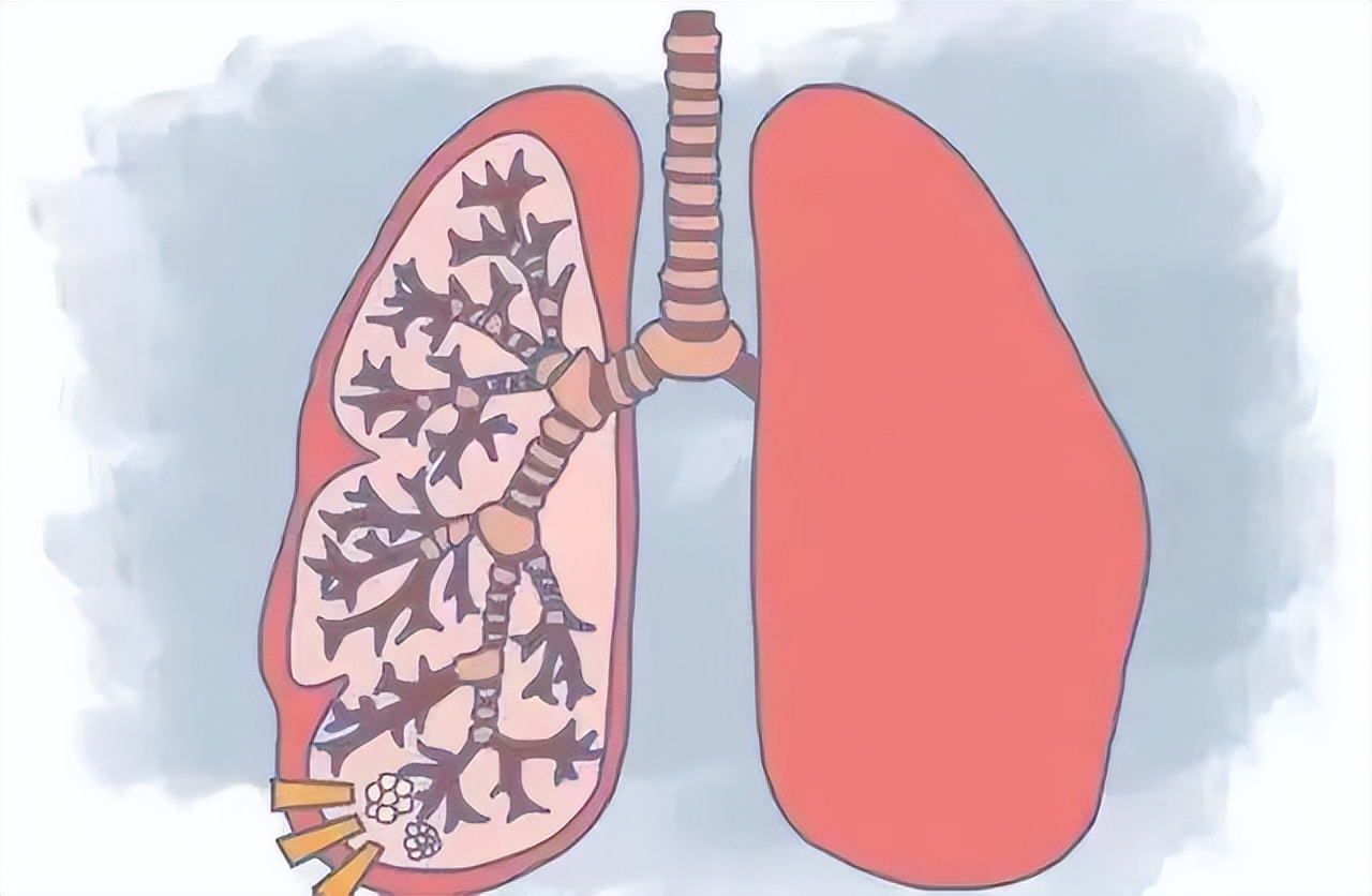 自发性气胸什么卧位,自发性气胸的病史