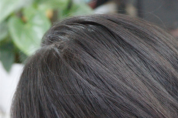 头皮屑大块严重是什么原因,头皮屑大块大块的怎么回事