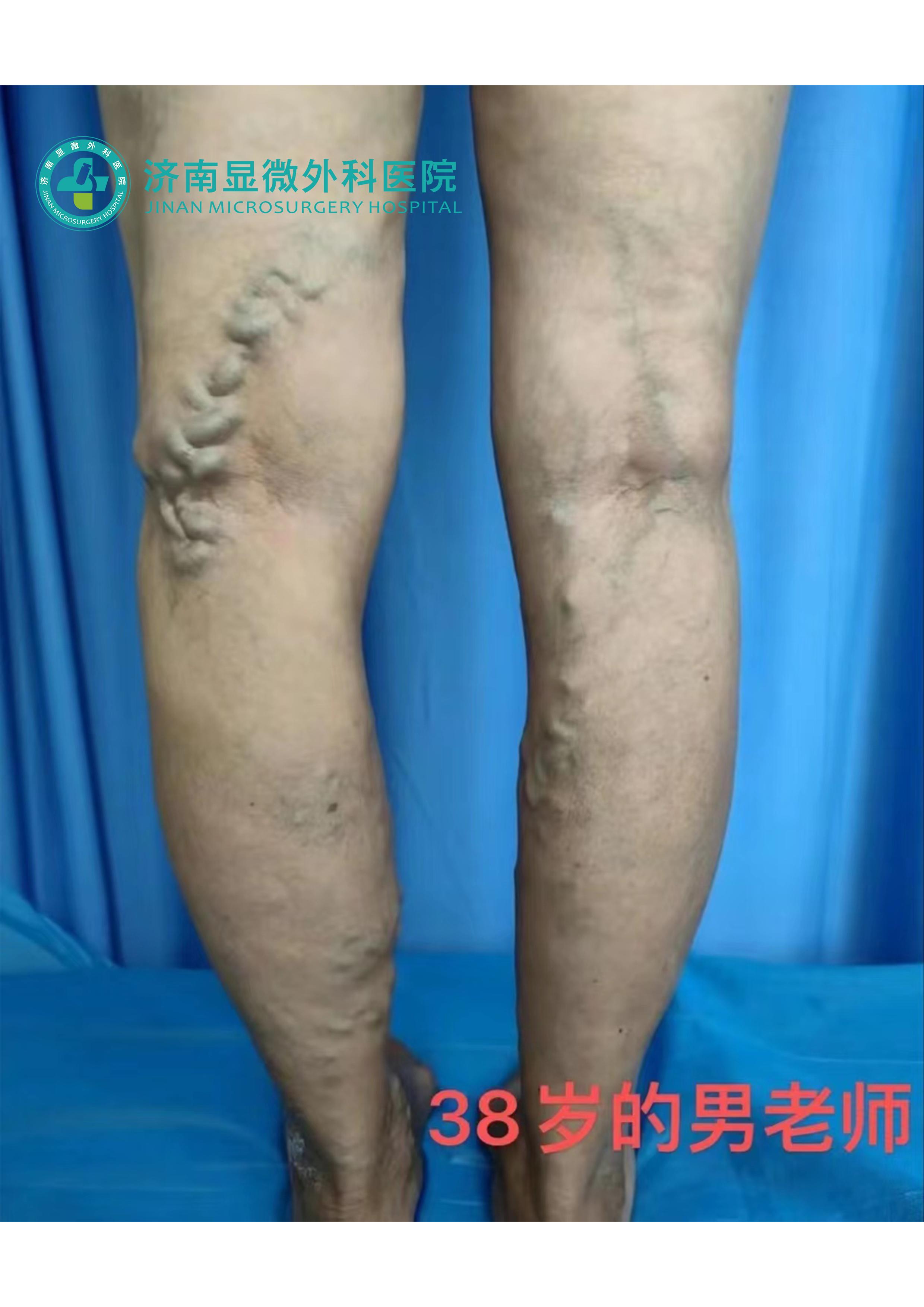 静脉曲张杨奎医生,静脉曲张患者去哪科治疗