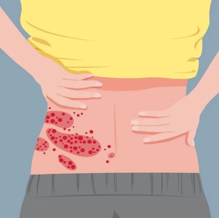 带状疱疹剧痛中医治疗,有一种剧痛叫带状疱疹