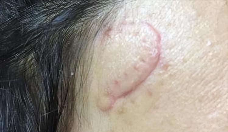 鼻子黑头里挤出的白色油脂怎么办,鼻子上有硬硬的黑头怎么办