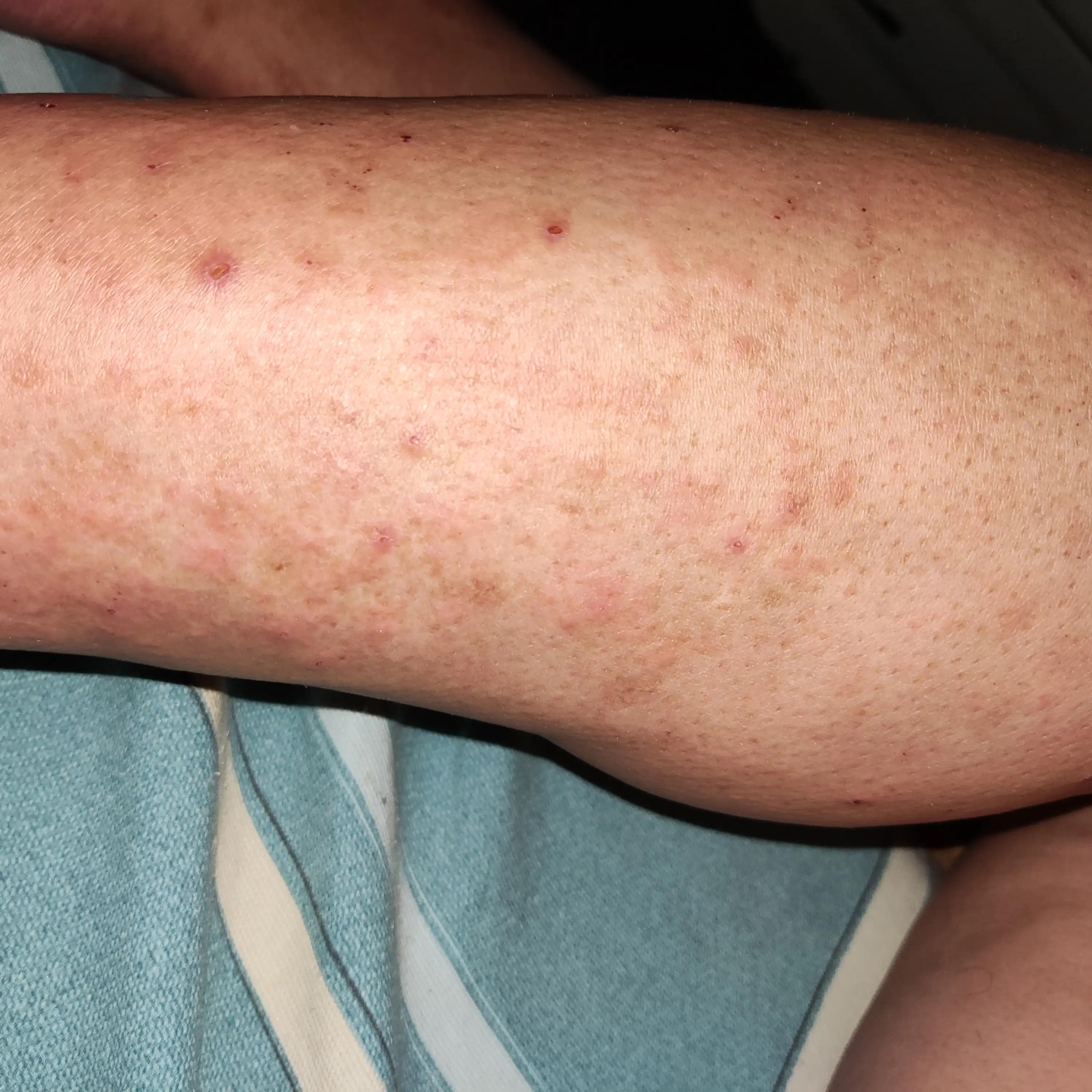 风疹不治疗可以自愈吗,风疹病毒治疗多少钱