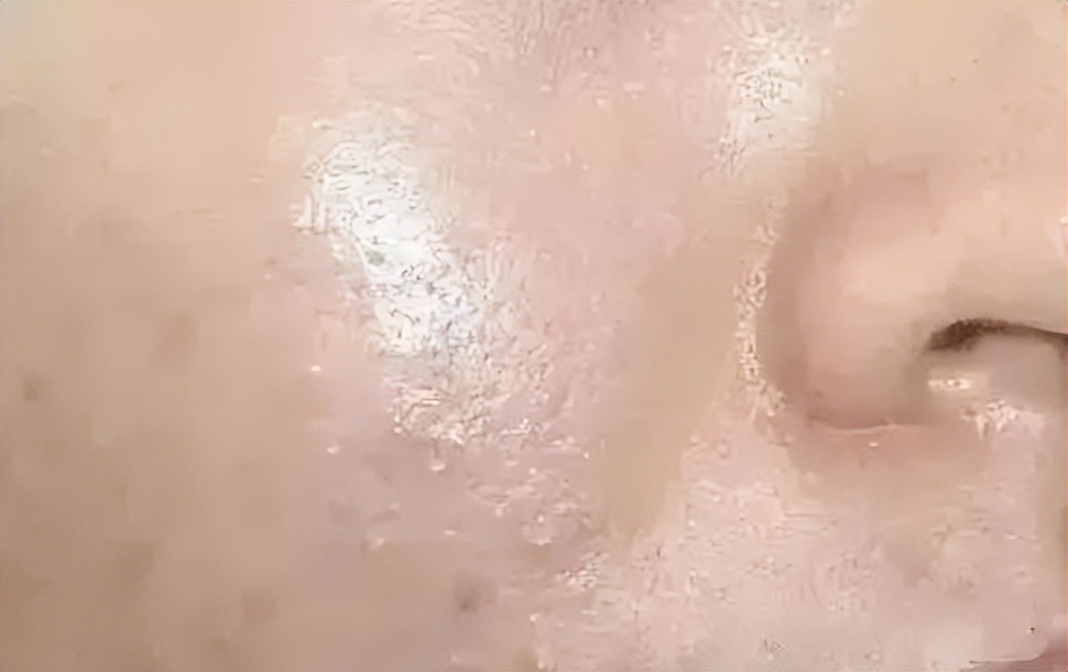 清洁面膜可以去黑头粉刺闭口吗,清洁面膜可以去除黑头吗