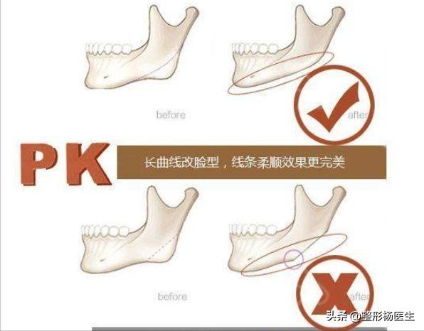 削骨后遗症最严重的后果,削骨失败案例后遗症