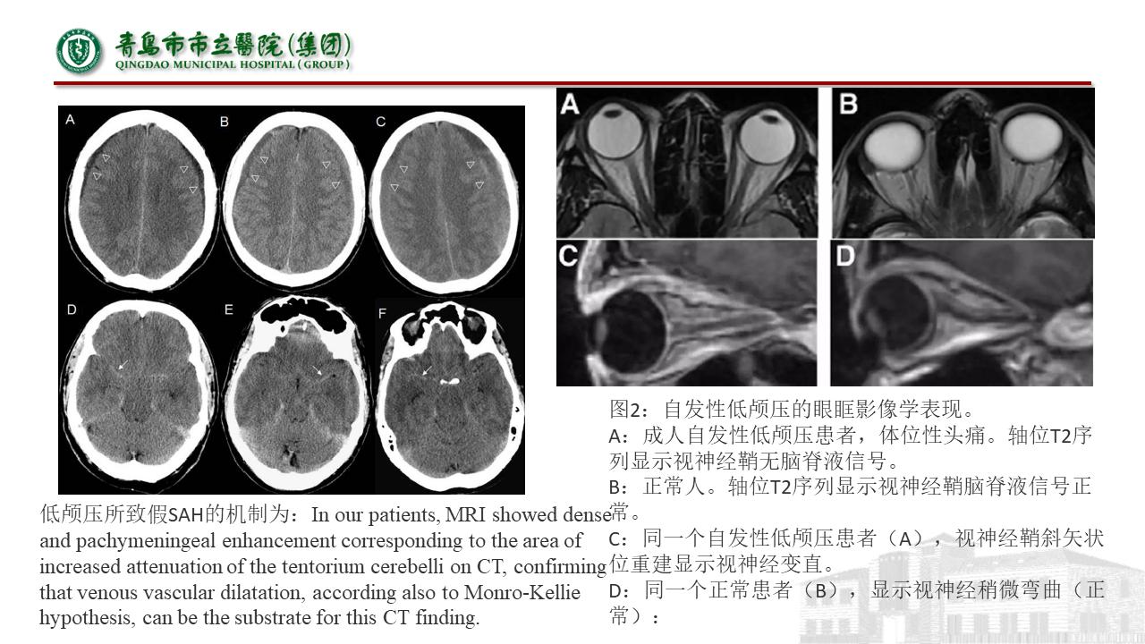 低颅压综合征耳闷,低颅压综合征吃什么药