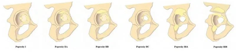 人工髋关节翻修术,人工髋关节翻修能翻修多少次