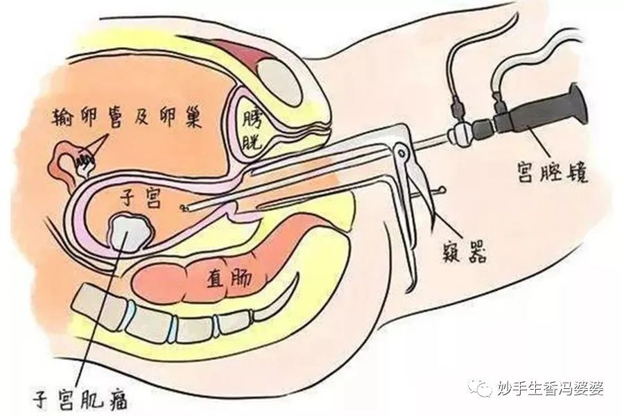 输卵管一边堵了一边切了怎么办,输卵管明明通了为啥又堵了