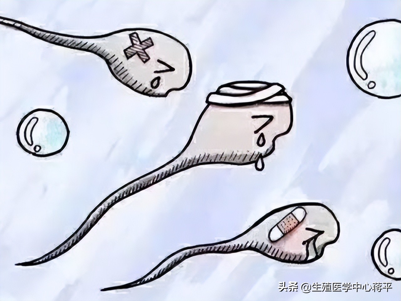 精子DNA碎片(DFI)临床意义及应用权威解读