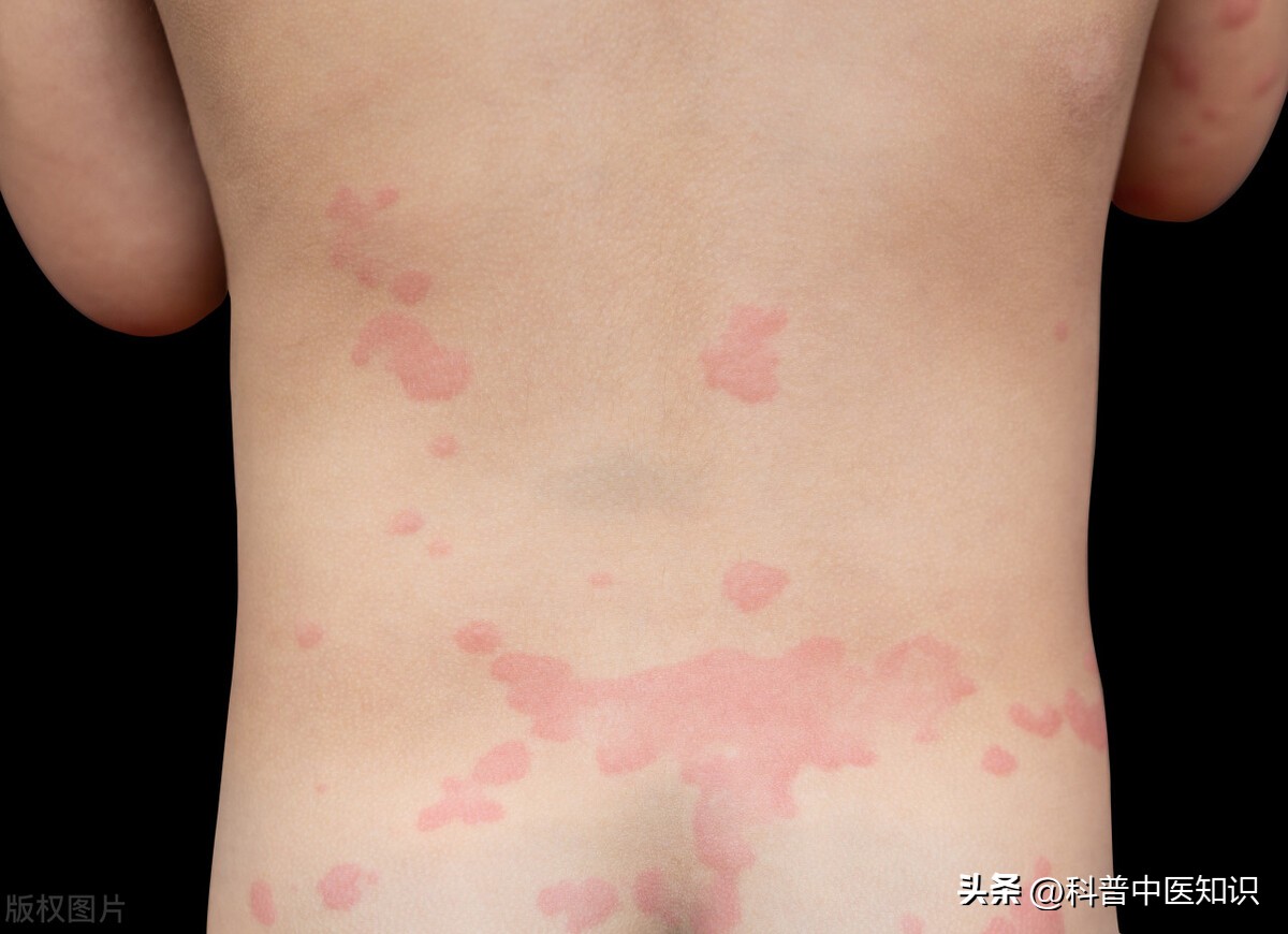 中医治疗荨麻疹医案,中医风邪引起的荨麻疹怎么治