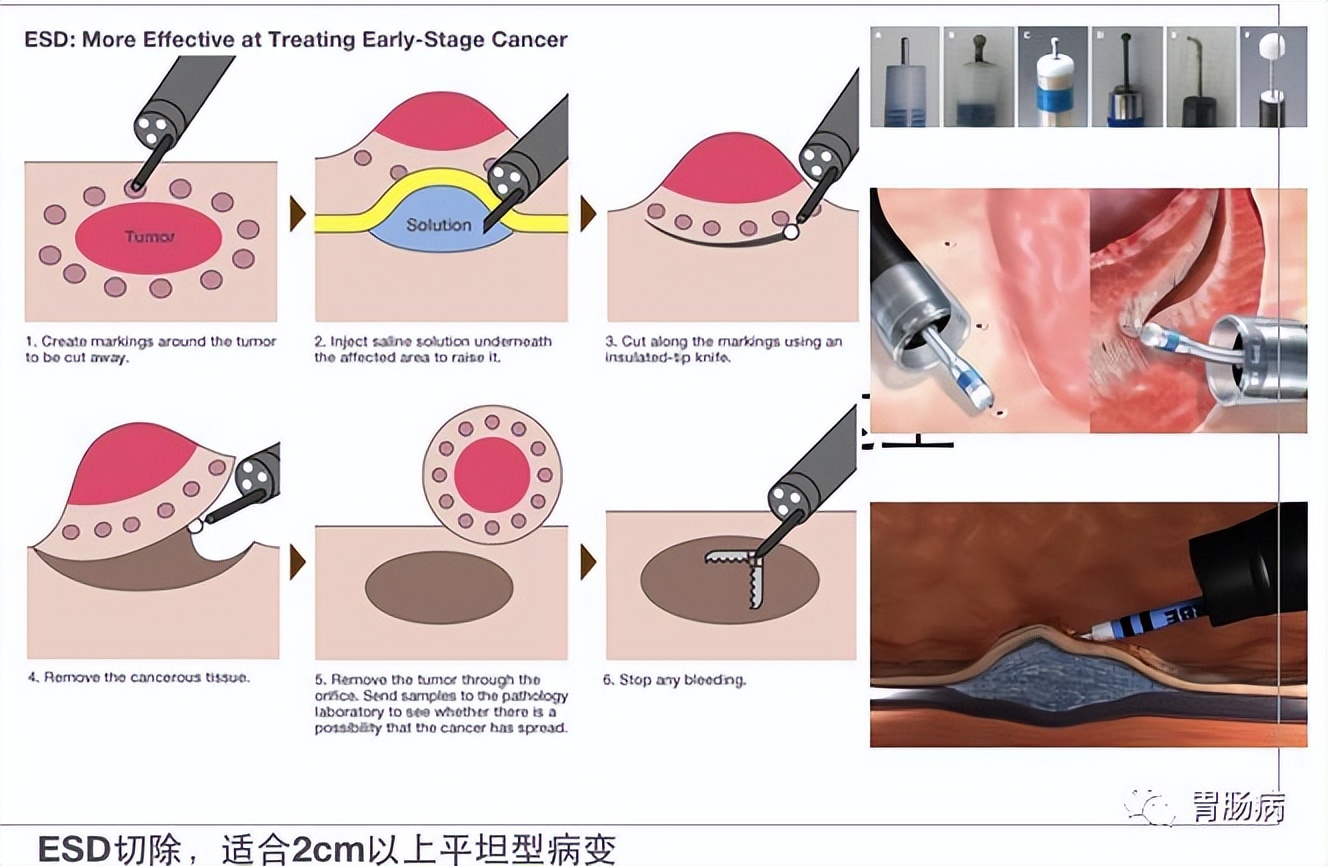 esd内镜下粘膜剥离几天可愈合,内镜下粘膜剥离术属于esd还是emr