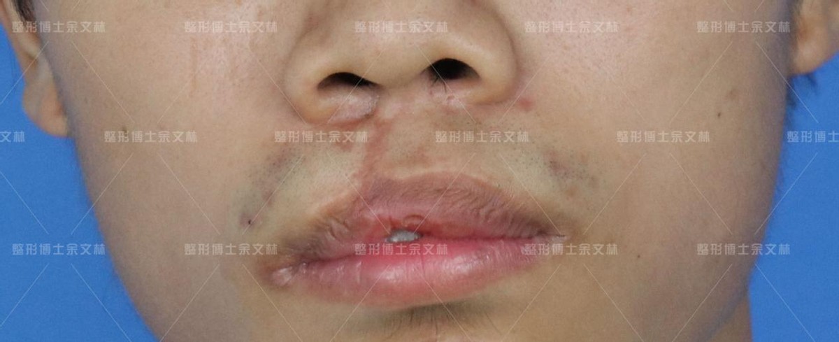 唇裂造成畸形牙矫正视频,唇裂缺陷怎么调理