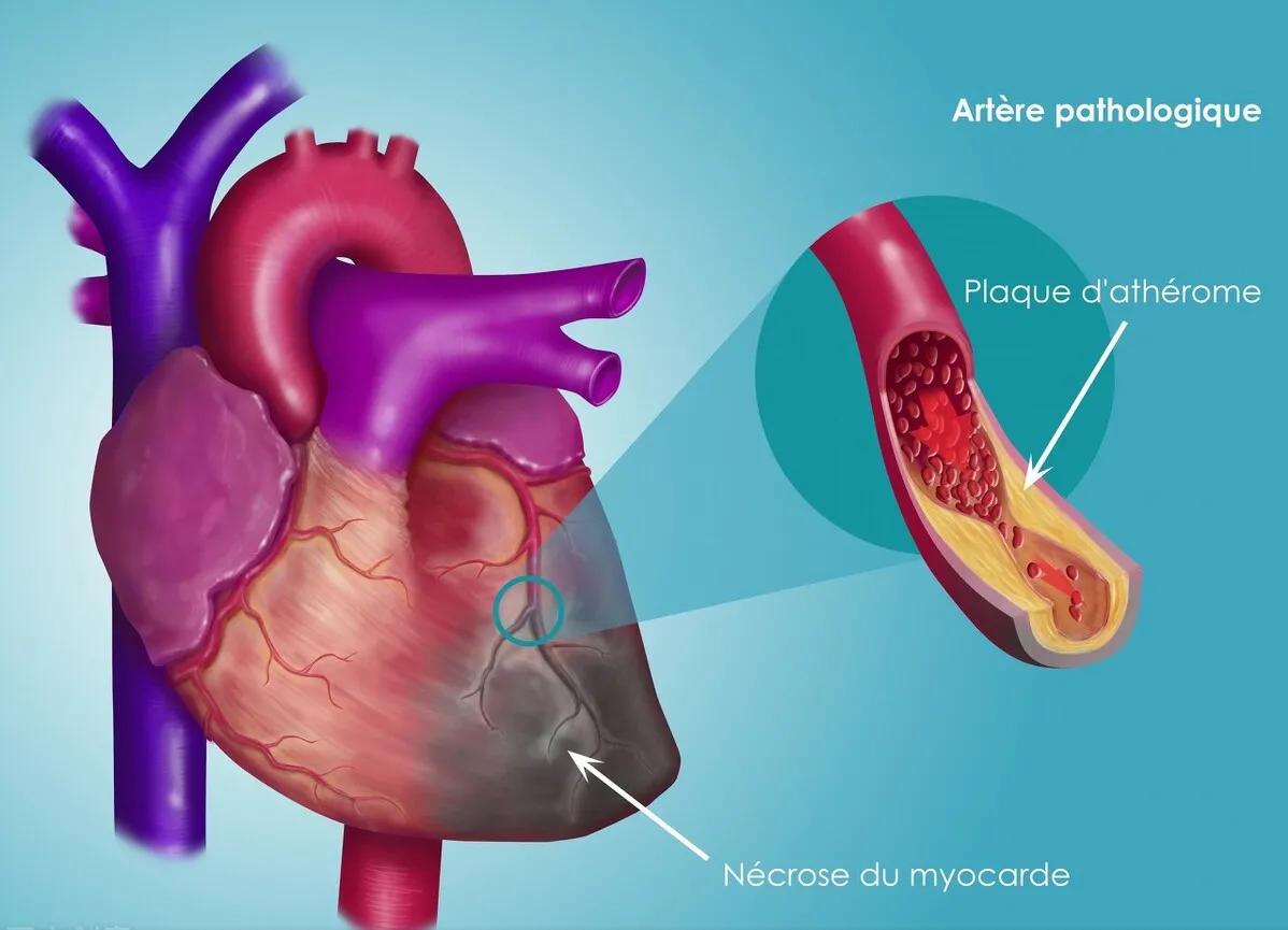 改善冠脉供血的常用药物,2个中成药降血压血脂