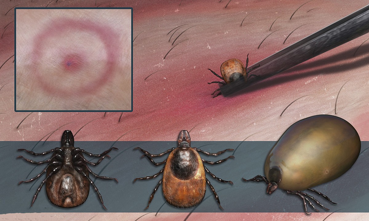 妈妈帮孩子理发发现蜱虫,小孩儿头上发现有蜱虫