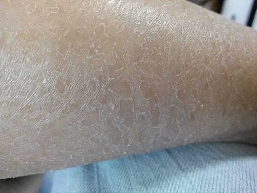 每到秋天，手和腿上就会出现各种干燥情况，还会脱皮，要怎么办？