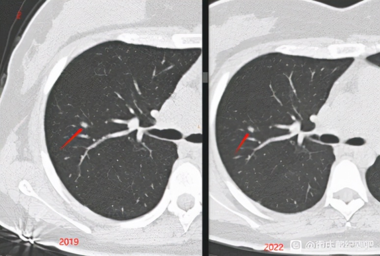 磨玻璃结节生长在右下方,磨玻璃结节微浸润靠近肺门