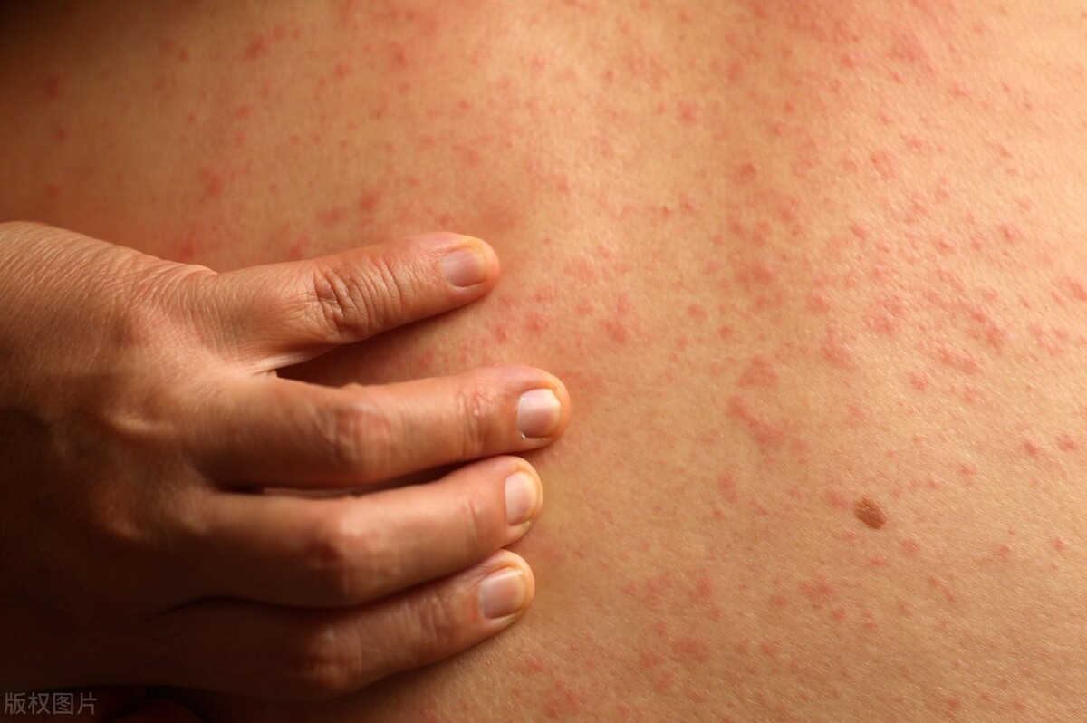 对钱和男性精液过敏，“奇葩”的5个过敏原，你还知道哪些?