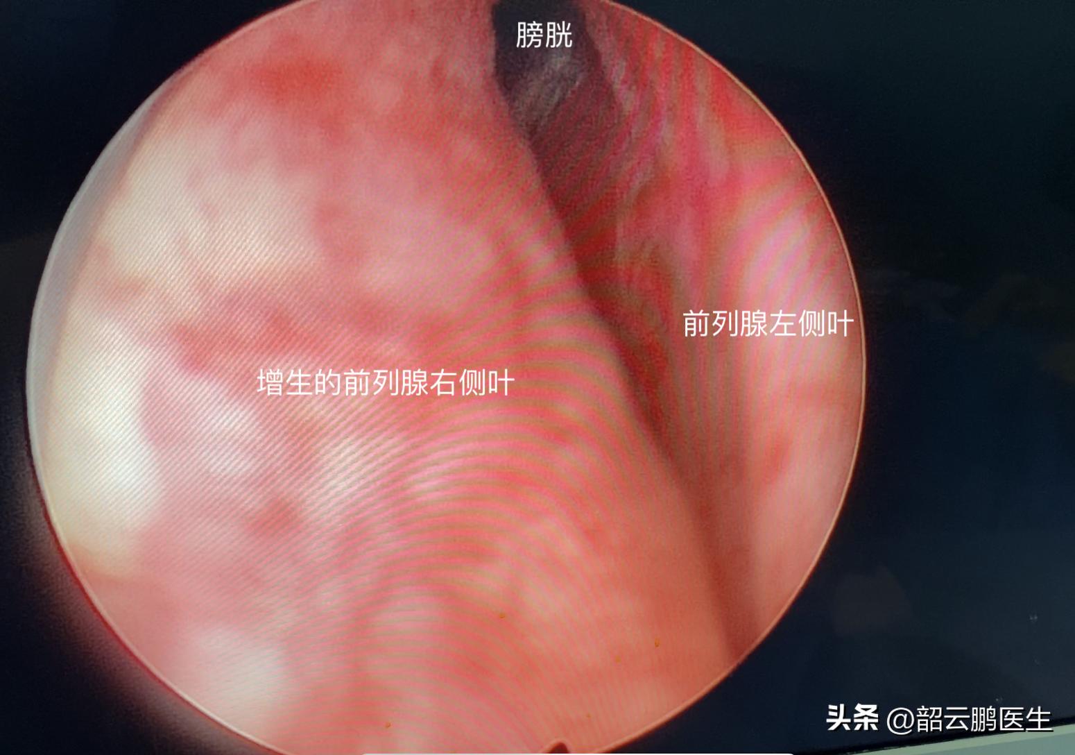 内消瘰疬丸治不治前列腺增生,前列腺增生可以做什么运动改善吗