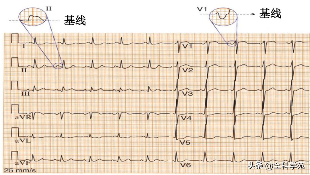 心电图分析窦性心律1100正常吗,心电图p波为窦性怎么看