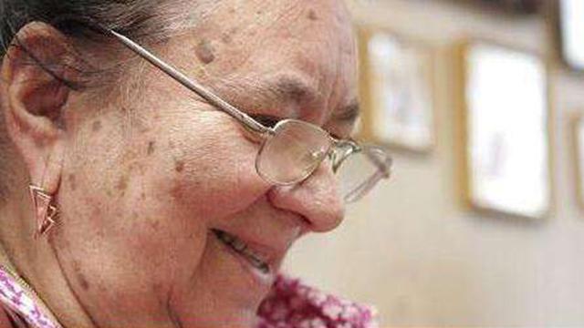 红霉素软膏去老年斑小妙招,红霉素软膏真的能祛除老年斑吗