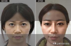 隆鼻后为什么没用夹板,隆鼻后鼻头感觉有点歪怎么办