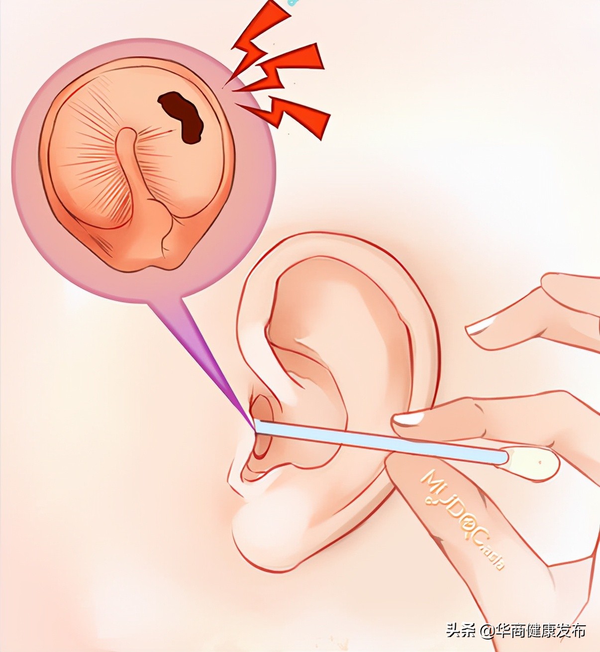 打一巴掌耳膜穿孔严重算犯罪么,一巴掌导致鼓膜穿孔