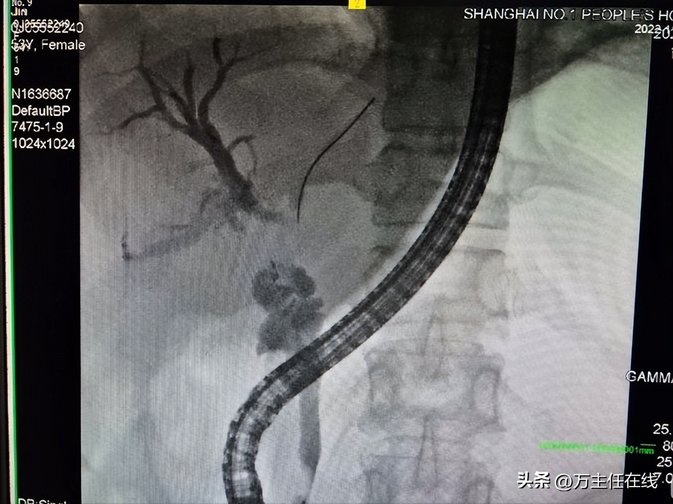 胆结石化脓性胆囊炎,妙手神针巧治疑难杂症