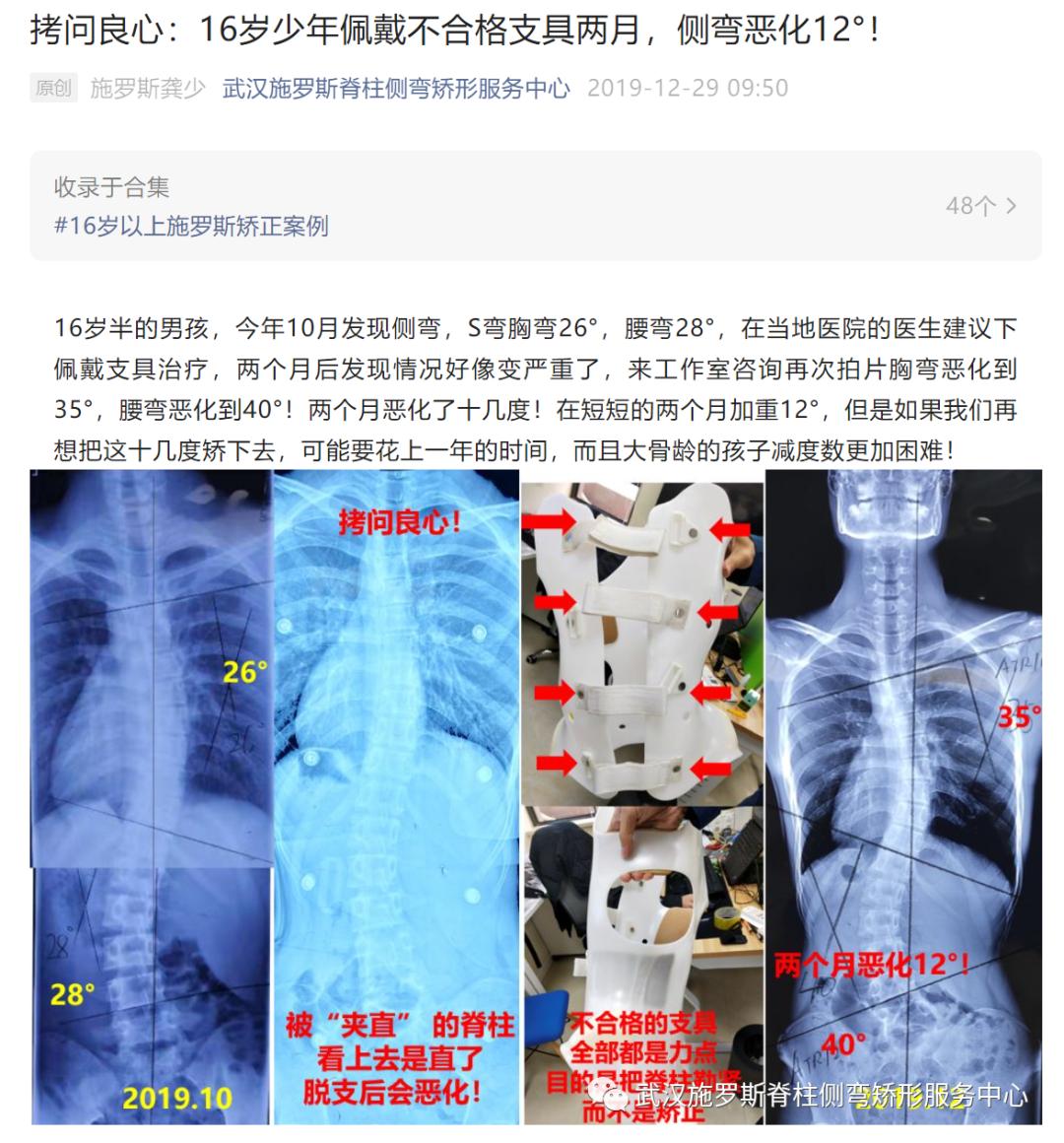 脊柱侧弯矫正支具不调整会怎样,简单辨别脊柱侧弯避免孩子走弯路