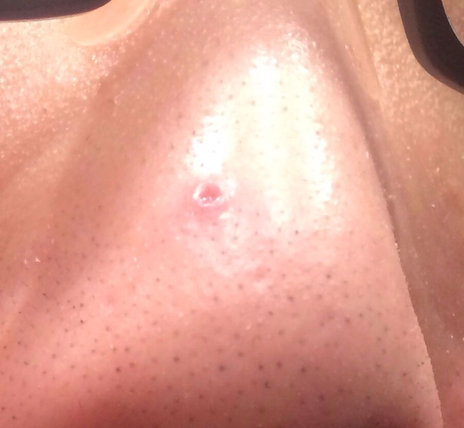 为什么鼻子可以挤出很大的黑头,用夹子挤出鼻子黑头