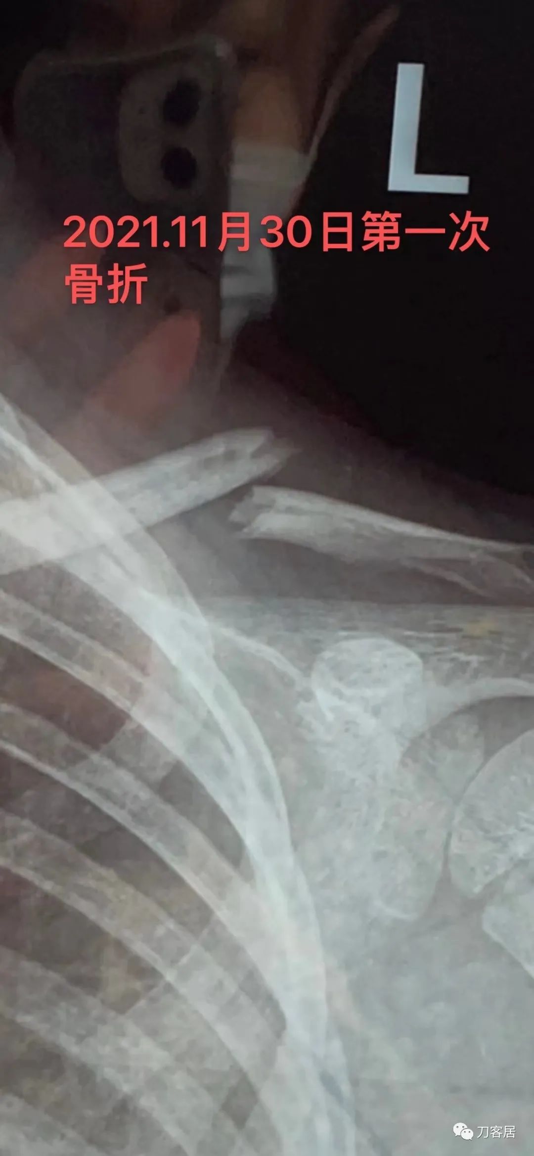 儿童锁骨骨折保守治疗的弊端,锁骨粉碎骨折错位不处理会愈合吗