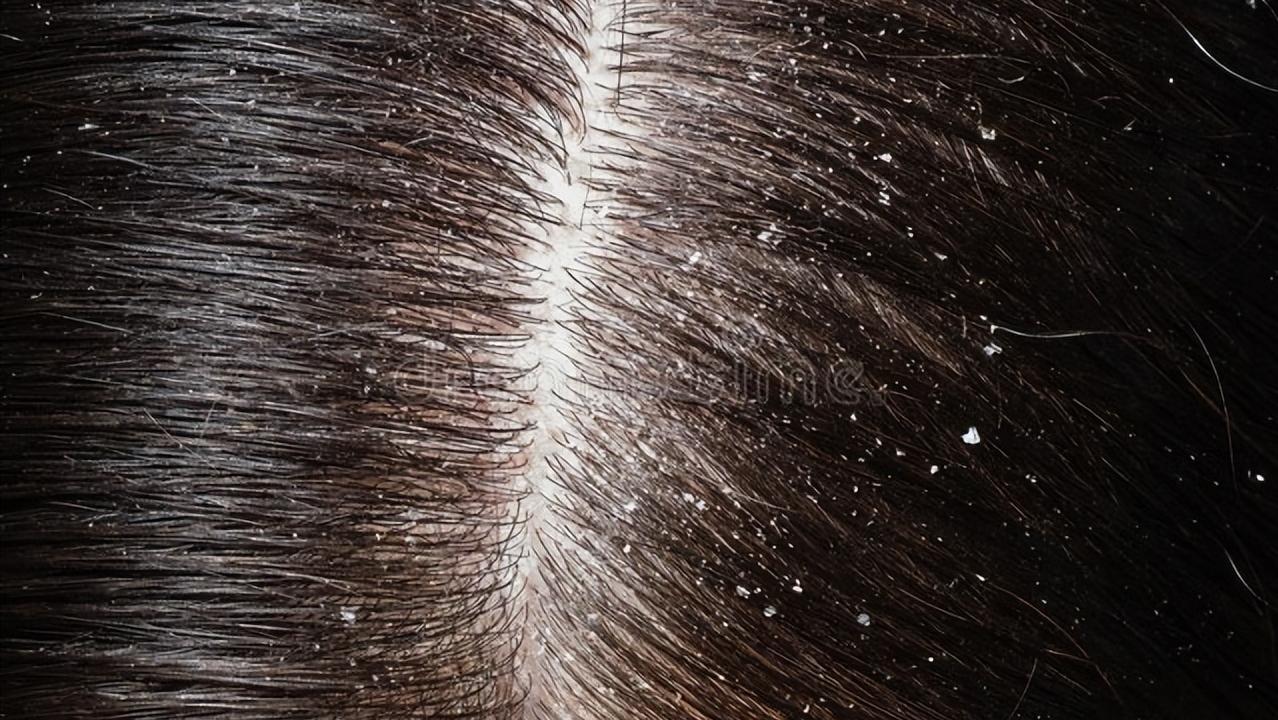 头皮屑太多是不是血虚,头皮屑多是因为有炎症么