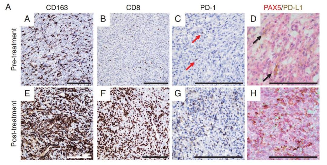 纳武单抗治疗肺癌效果,纳武利尤单抗治疗胃癌转移骨癌