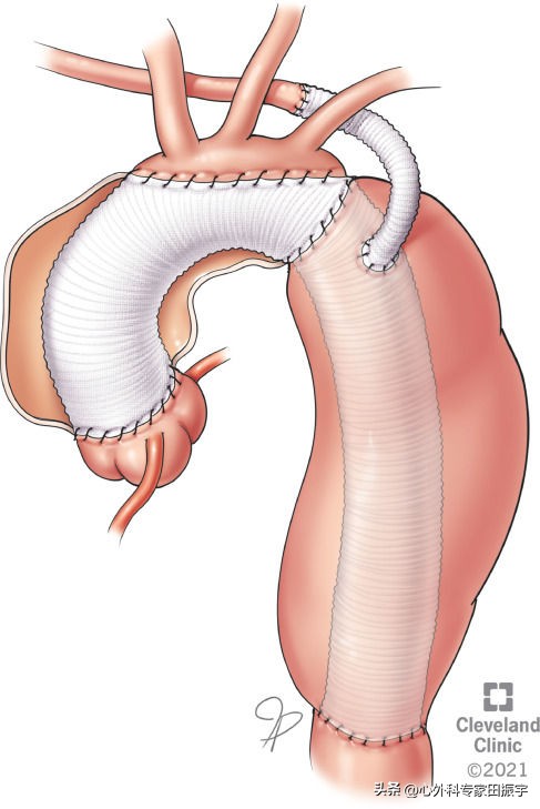 Kommerell憩室和迷走型锁骨下动脉修复术