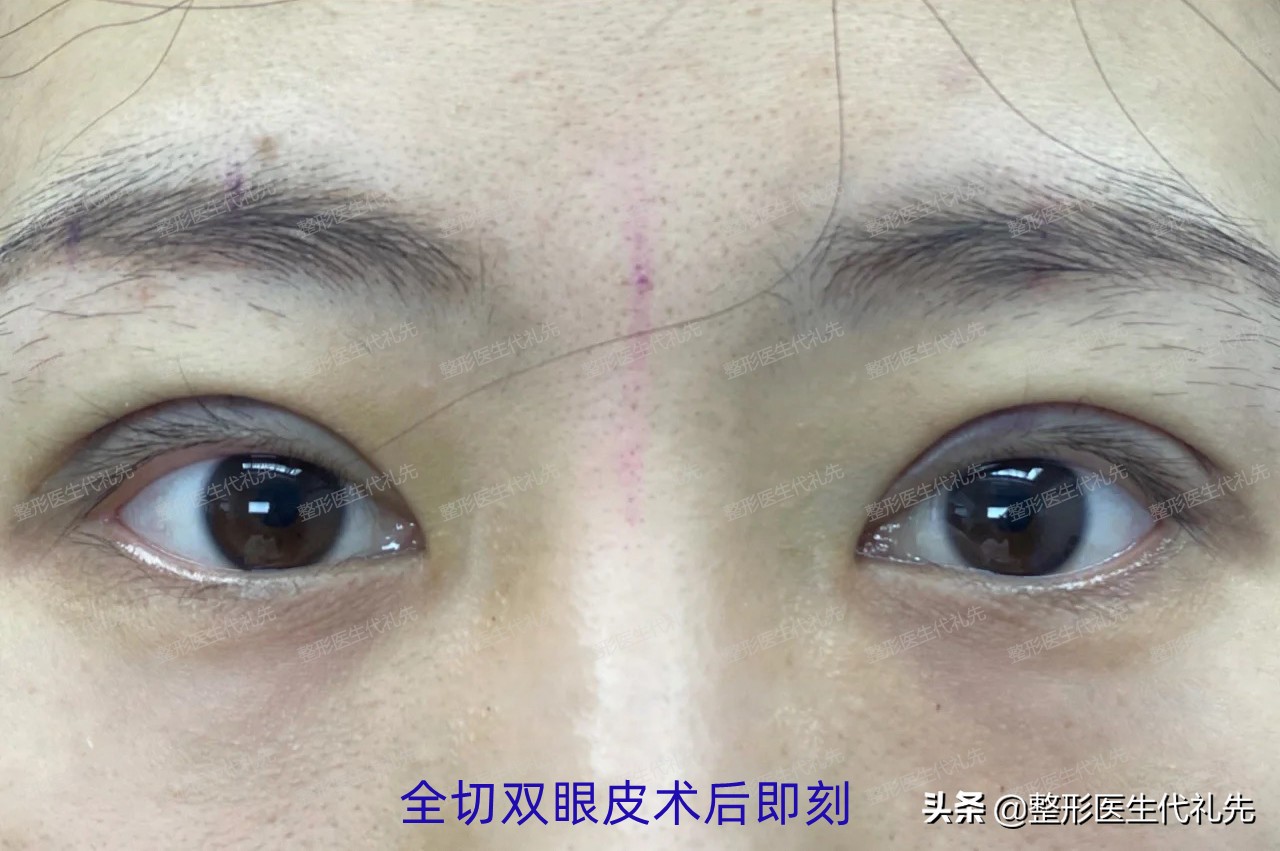 45岁全切双眼皮一月恢复过程,40岁全切双眼皮术后记录