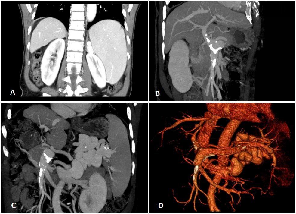 肝硬化失代偿期脾栓塞手术,肝硬化脾脏切除术
