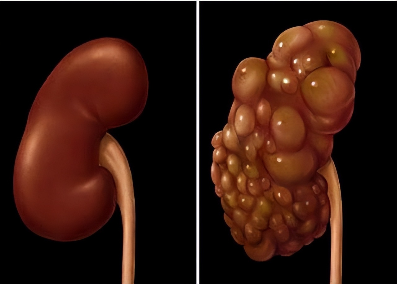 罗大伦中医前列腺增生方子,公认前列腺增生最有效的治疗手段